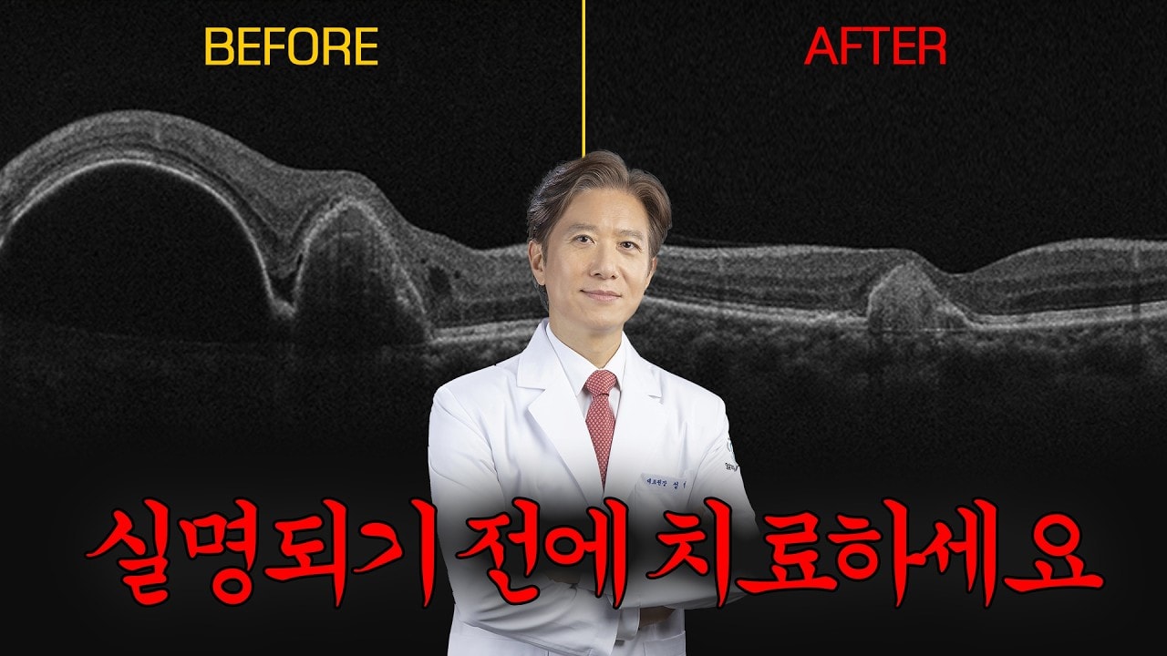 세상이 휘어보인다면 당장 병원 가세요. 황반변성, 치료 포기하면 발생하는 일 #황반변성자가진단 #자가진단법